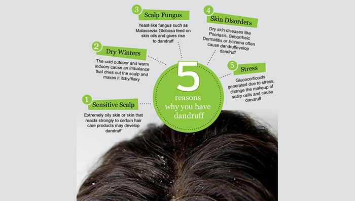 5 Reasons Why You Have Dandruff, How to Cure Dandruff