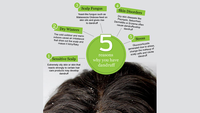 5 Reasons Why You Have Dandruff