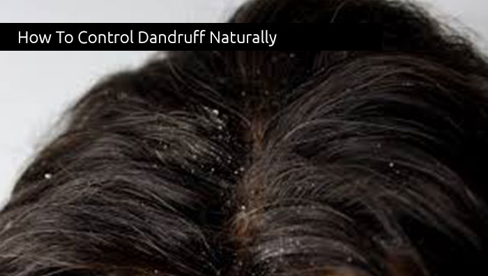 How To Control Dandruff Naturally