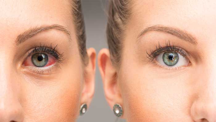 Home Remedies For Dryness Around Eyes