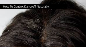 How To Control Dandruff Naturally