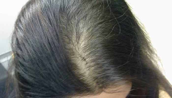 Women Suffering from Hair Loss