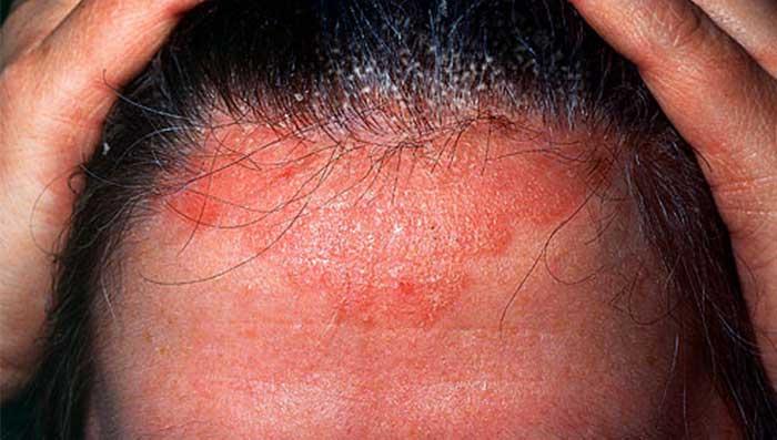 Scalp Psoriasis