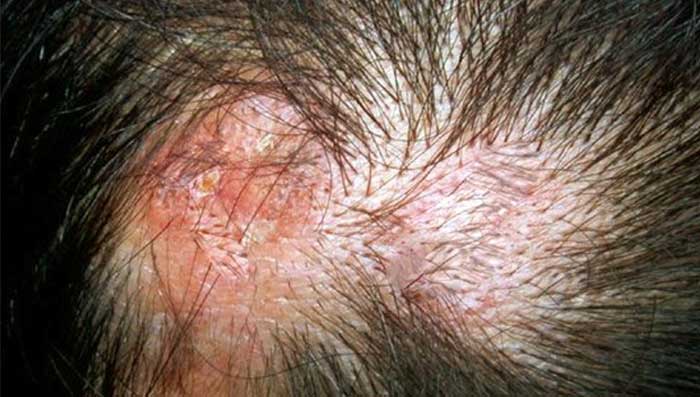 Viral & Bacterial Scalp Infection