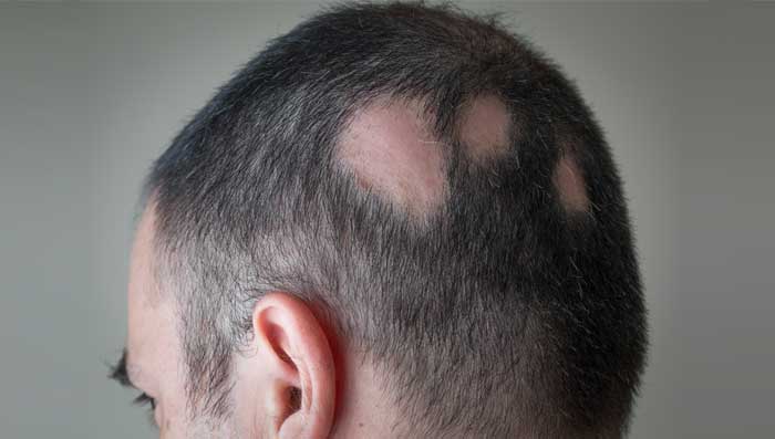 Alopecia