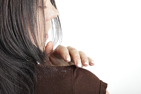 Shikakai for Hair Fall and Dandruff Control