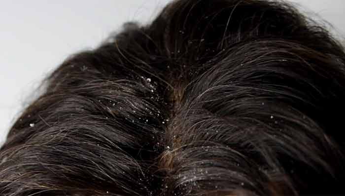 Coconut oil to treat dandruff