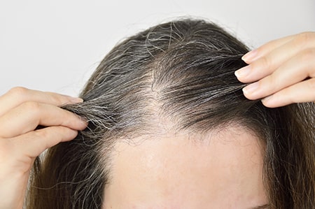 Biotin for Thyroid Hair Loss