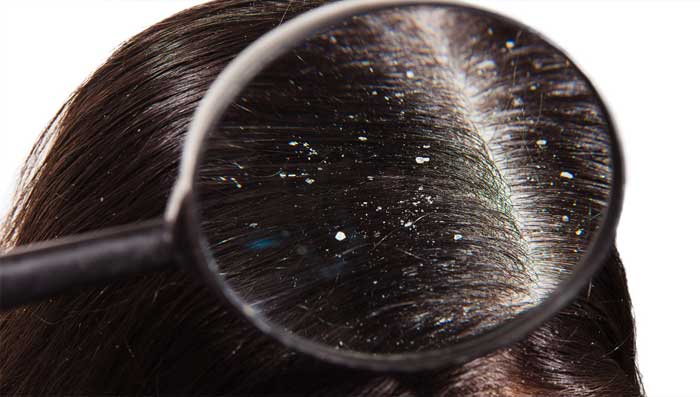 Monsoon Hair Care: Hair Fall in Monsoon Home Remedies & Reasons