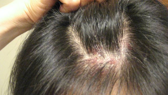 Suffering from scalp psoriasis