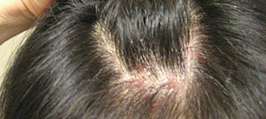 Suffering from scalp psoriasis
